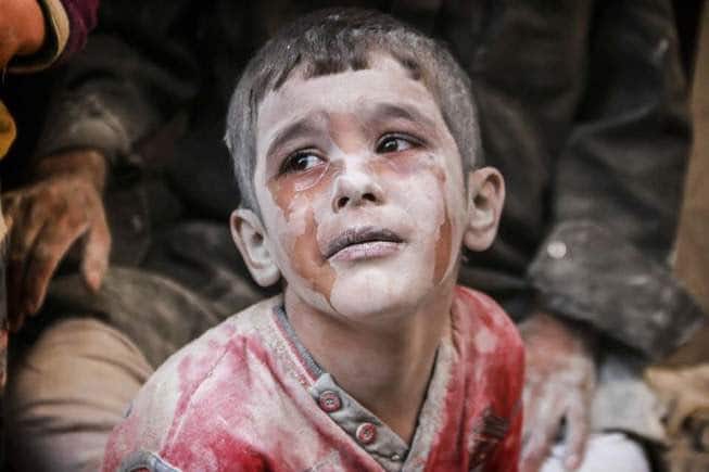 طفل مصاب في سوريا