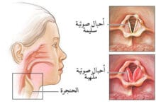 علاج التهاب الحنجرة بالاعشاب