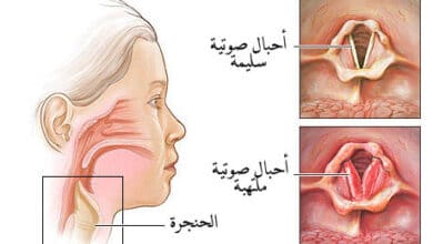 علاج التهاب الحنجرة بالاعشاب