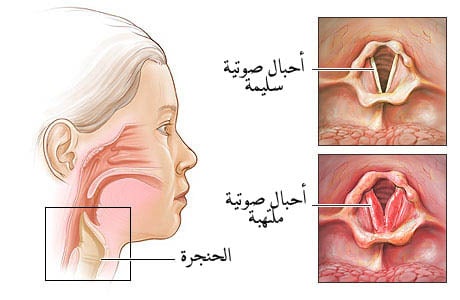 علاج التهاب الحنجرة بالاعشاب