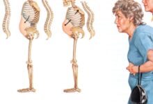 اعراض هشاشة العظام