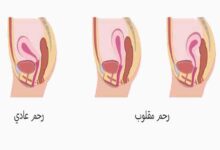 الرحم المقلوب ونوع الجنين