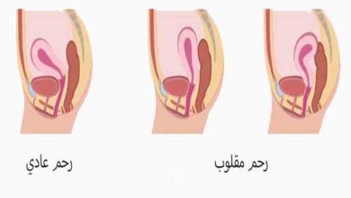 الرحم المقلوب ونوع الجنين